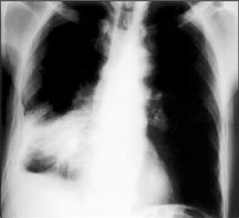 Figure 1 From Primary Lymphoepithelioma Like Carcinoma Of The Lung