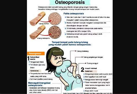 Cegah Osteoporosis Dengan Menabung Tulang Sejak Dini Indonesia