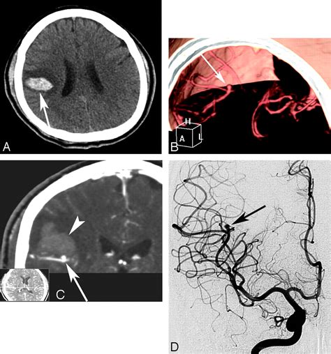 Multidetector Row Ct Angiography In Spontaneous Lobar Intracerebral Hemorrhage A Prospective