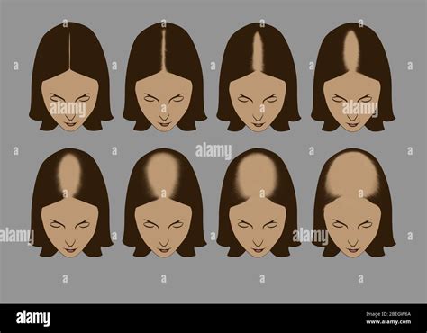 Female Hair Loss Stages Hi Res Stock Photography And Images Alamy