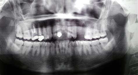 Maestría en Endodoncia y Microcirugía Apical