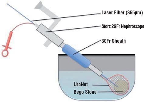 Figure 1 From Does Stone Entrapment With ″uro Net″ Improve Hoyag Laser