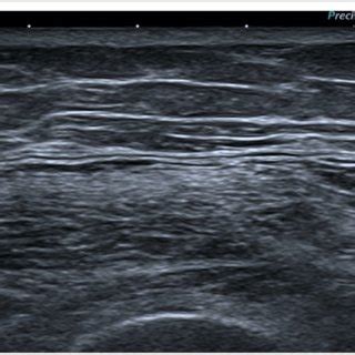 B Mode Ultrasound Showing A Transverse View Of The Vastus Lateralis In