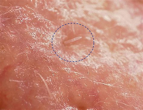 Microscopic Parasites On Human Skin