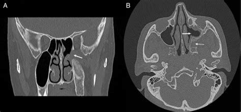 Postoperative CT images. (A) Coronal CT scan. There is no tumor... | Download Scientific Diagram