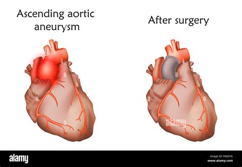 Ascending Aortic Aneurysm Before And After Repair With A Tube Graft