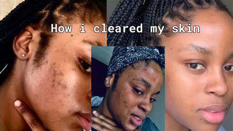 Tips On How To Clear Your Acne My Acne Journey How I Cleared My