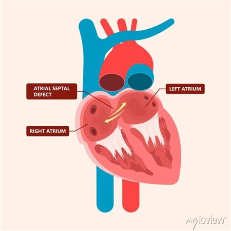 Cath Lab Atrial Septal Defect Tetralogy Of Fallot Patent Foramen Canvas