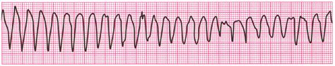 Taquicardia Ventricular Polimorfica Cptc Healthpoint