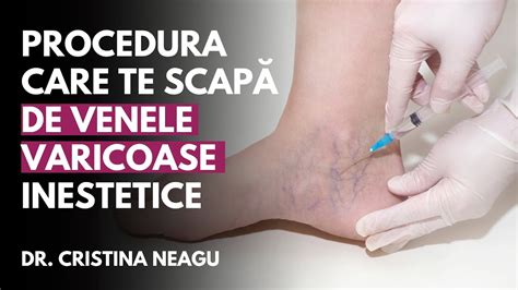 Scleroterapia Procedura Care Te Scap De Venele Varicoase Inestetice