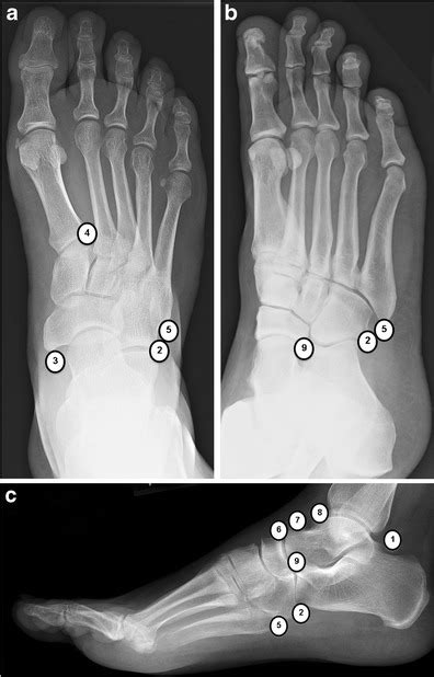 Accessory ossicles of the foot. AP (a), oblique (b) and lateral (c)... | Download Scientific Diagram