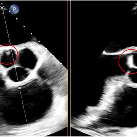 Tee Depicting Aortic Valve Vegetation Measuring 8 Mm × 10 Mm Circled Download Scientific