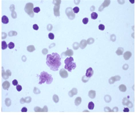 Peripheral Blood Smear Leishman Stain Showing Smudge Cells