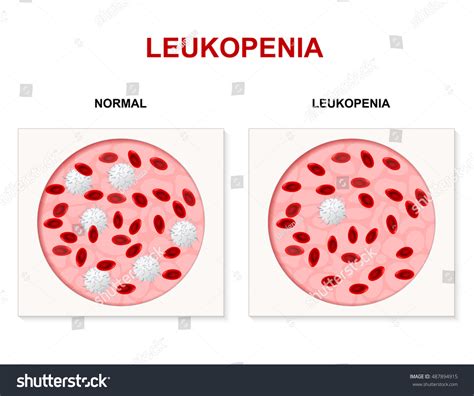 230 Leucopenia Images, Stock Photos, 3D objects, & Vectors | Shutterstock