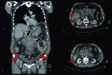 Computed tomography (CT) imaging of the abdomen with intravenous... | Download Scientific Diagram