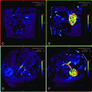 Pdf Utilizing Flat Panel Detector Parenchymal Blood Volume Imaging