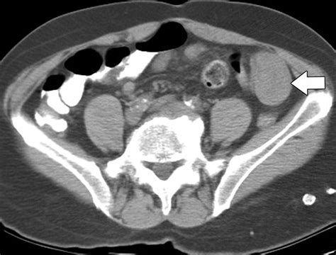 Adult Intestinal Intussusception Ct Appearances And Identification Of A Causative Lead Point