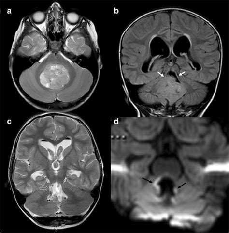 A 9 Year Old Girl Presented With A Posterior Fossa Mass Occupying The Download Scientific