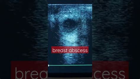 Breast Abscess Youtube