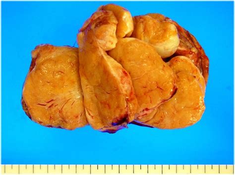 Resected ovarian tumor before the fixation. Tumor totally replaced the ...