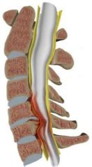 Canal cervical étroit Service de Neurochirurgie Hôpital Lariboisière