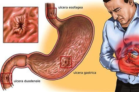 Respecto a la GASTRITIS Y ÚLCERAS causadas por Helicobacter Pylori