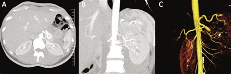 Axial A Coronal B And Volume Rendering Technique VRT Of Computed