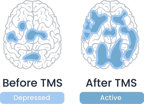 Tms Therapy Edmonton Transcranial Magnetic Stimulation Treatment