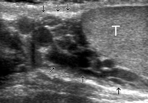 Gray Scale And Color Doppler Sonography Of Scrotal Disorders In