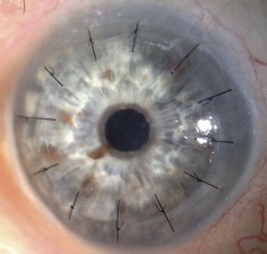 Keratoplasty In Ocular Surface Disease Clinical Gate