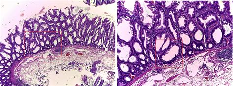 GASTROINTESTINAL AND LIVER HISTOLOGY PATHOLOGY ATLAS: SESSILE SERRATED ...