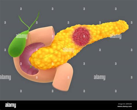 Tumor Neuroendocrino Fotograf As E Im Genes De Alta Resoluci N Alamy