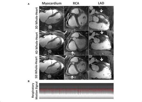 A Comparison Of The Myocardium The RCA And LAD Coronary Arteries