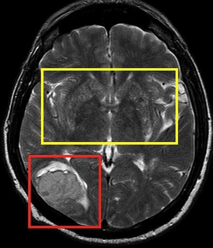 Lacunar Stroke Symptoms Prognosis And Recovery