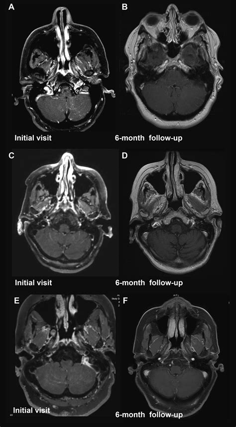 Cerebellar Leptomeningeal Enhancement An Imaging Finding Of Rapidly