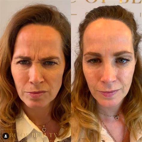 Is Een Behandeling Met Botox Iets Voor Jou Arc Of Beauty Botox En