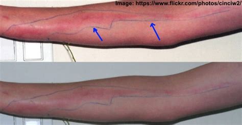 Blood Poisoning - Signs and Symptoms You Shouldn't Ignore
