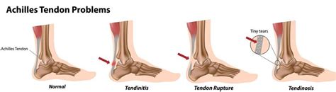 Achilles Tendonitis Treatment Phoenix Insertional Tendinitis