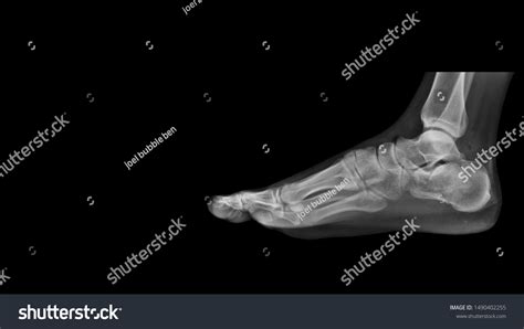 Film Ankle X Ray Radiograph Showing Stock Photo 1490402255 Shutterstock