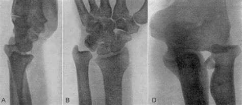 Essex Lopresti Fracture LITFL Medical Eponym Library