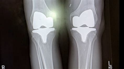 DePuy Touts Benefits Of Attune Knee Despite High Failure, 59% OFF