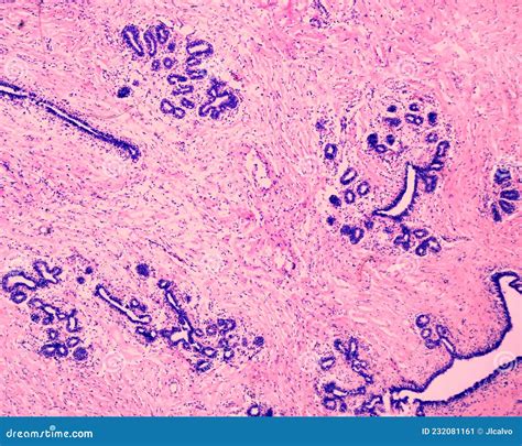 Human Breast Gland Adenosis Excretory Ducts Stock Photography