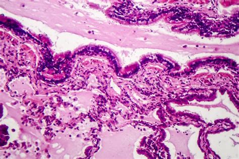 Lung Adenocarcinoma Stock Image Image Of Histology 130900689