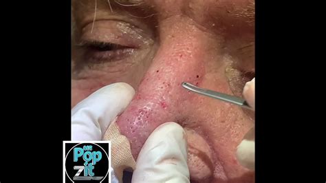 9 Minutes Of Non Stop Blackheadwhitehead Pops Cyst Pops Acne