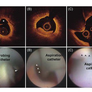 Representative Images Of Culprit Plaque Morphologies Of Acute Coronary