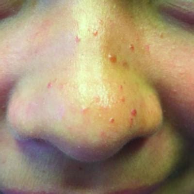 A 7-year-old with red bumps on her nose | MDedge Family Medicine