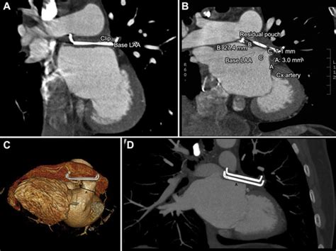 Thoracoscopic Left Atrial Appendage Clipping A Multicenter Cohort