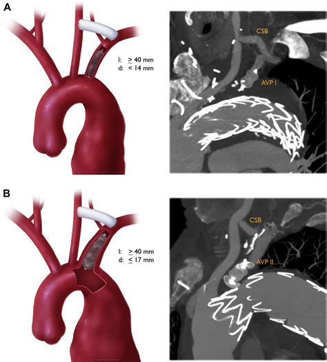 Schematic Drawings And Postoperative Computed Tomography Ct Scan Of Download Scientific