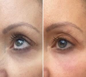 Before And After Polynucleotide Simple Radiance Medspa