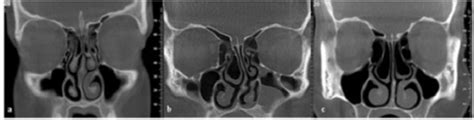 Diagnosis Deviasi Septum Nasal Alomedika